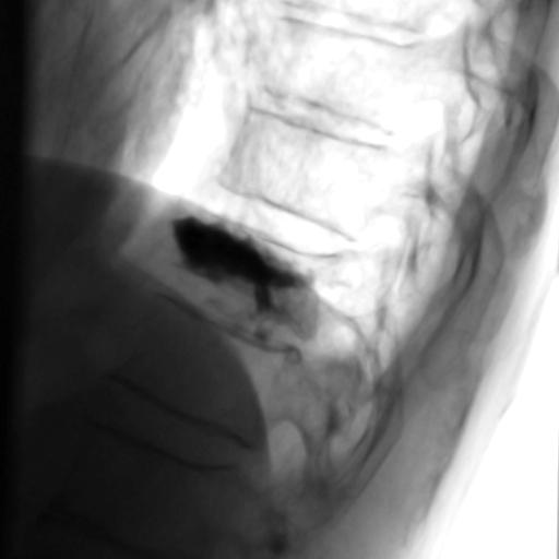 Vertebroplastika3