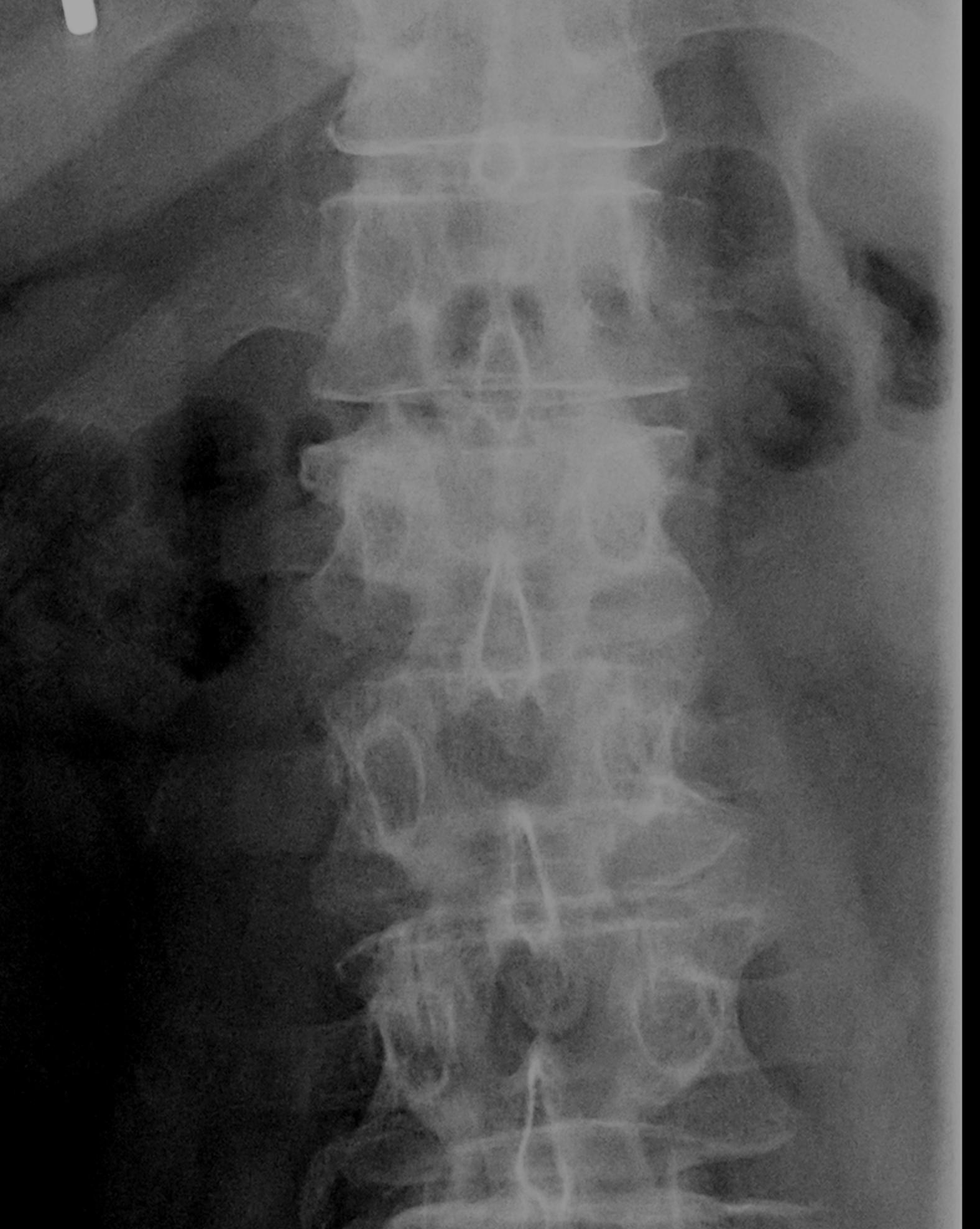 Vertebroplastika10