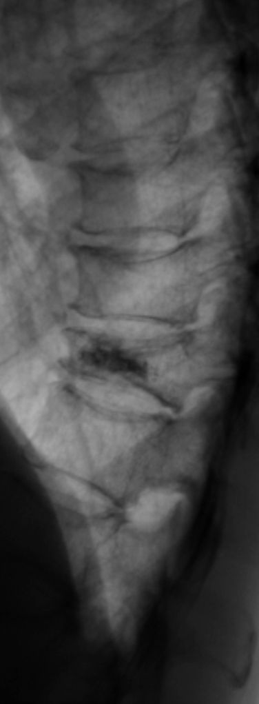 VertebroplastikaM1.jpg